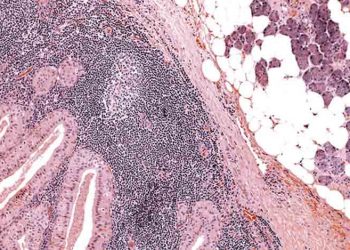 Warthin Tümörü Nedir?