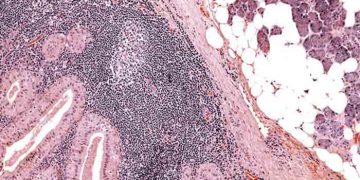 Warthin Tümörü Nedir?