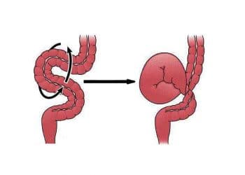 Volvulus İntestini Nedir?