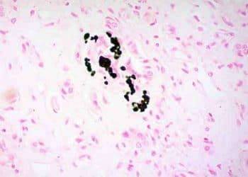 Von Kossa Boyama Yöntemi Nedir?