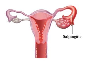 Salpingitis Nedir?