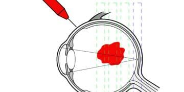 Vitreus Paresentezi Nedir?