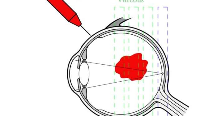 Vitreus Paresentezi Nedir?