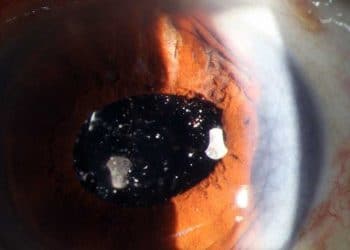 Vitreus Prolapsusu Nedir?