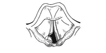 Vokal Kordektomi Nedir?
