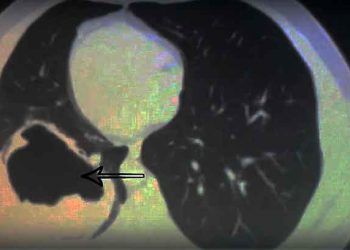 Virchow Hidatit Nedir?