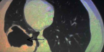 Virchow Hidatit Nedir?