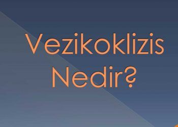 Vezikoklizis Nedir?