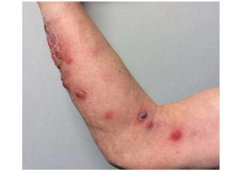 Sporotrikoz (Sporotrichosis) Mantar Hastalığı