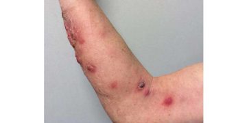 Sporotrikoz (Sporotrichosis) Mantar Hastalığı