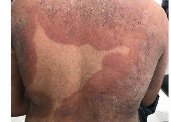 Trikofiti (Trichophyton) Mantar Hastalığı