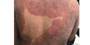 Trikofiti (Trichophyton) Mantar Hastalığı